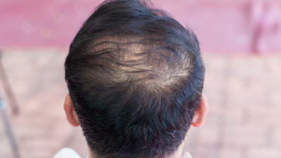 Thinning Hair In Men: Causes, Early Signs, And Science-Backed Support