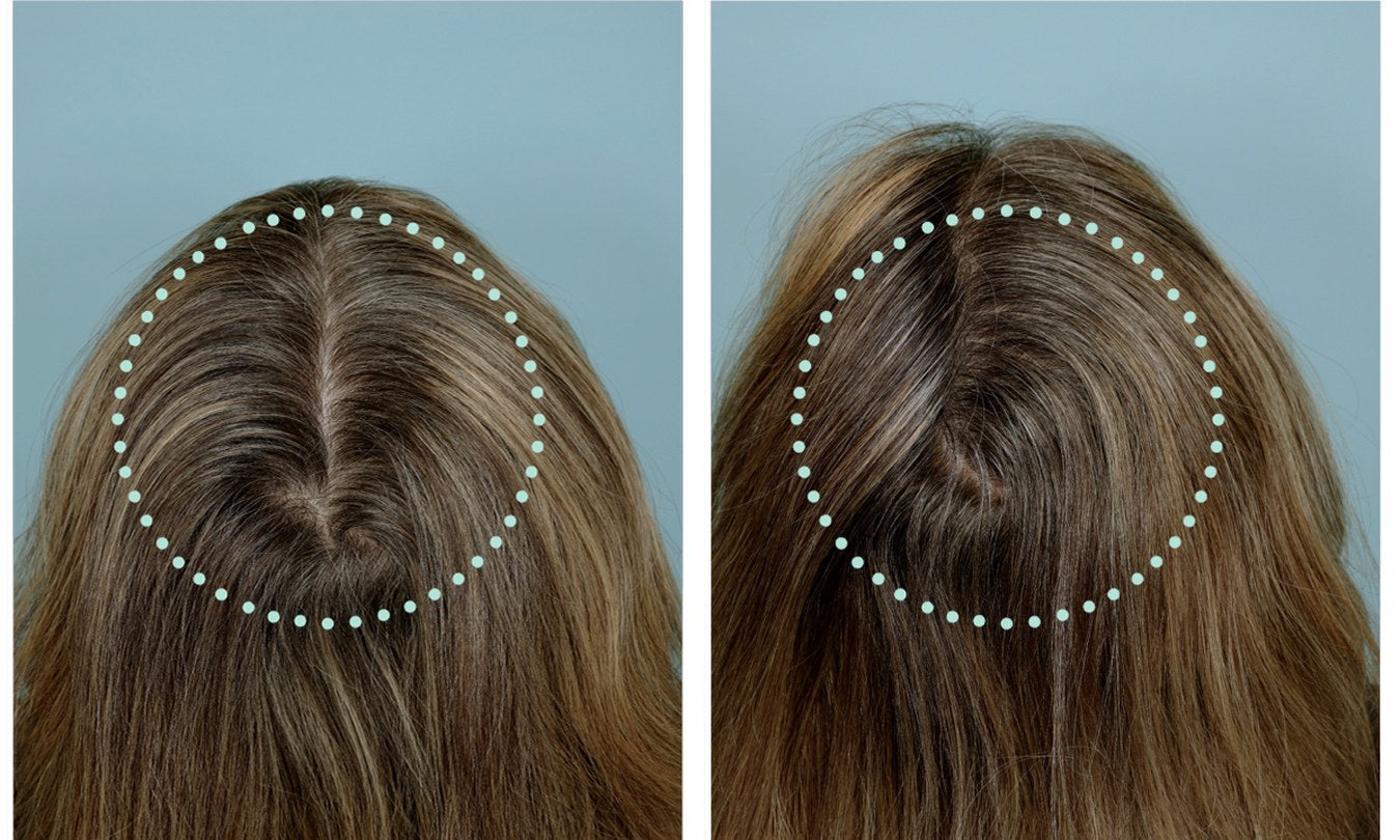 Month 0 to Month 6 hair density comparison